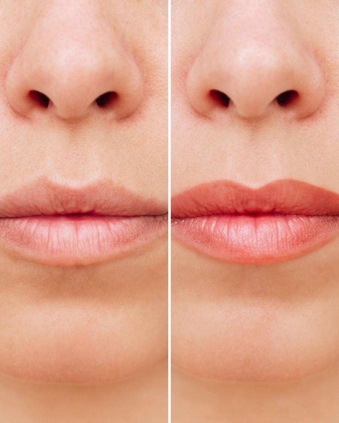 Lip Pigmentation Treatment